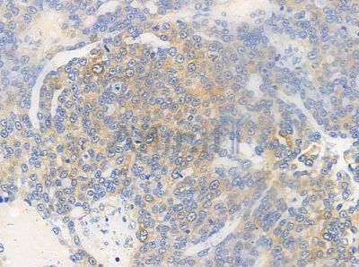 GPR153 Antibody - DF4898 at 1/100 staining human ovarian carcinoma by IHC-P.