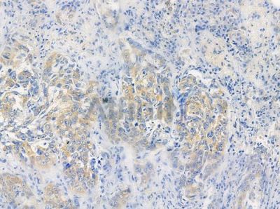 GPR153 Antibody - DF4898 at 1/100 staining human lung squamous cell carcinoma by IHC-P.