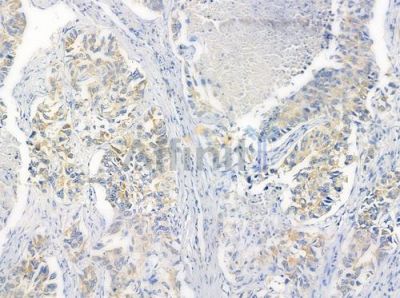 CLTR1 Antibody - DF4916 at 1/100 staining human lung squamous cell carcinoma by IHC-P.