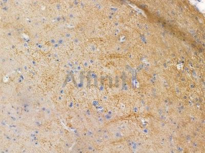 CLTR1 Antibody - DF4916 at 1/100 staining human glioblastoma by IHC-P.