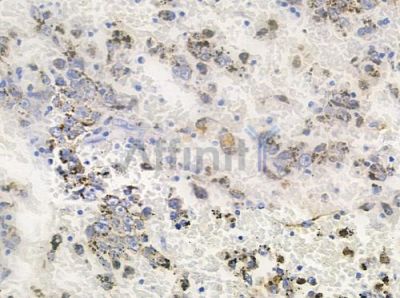 GPR174 Antibody - DF4960 at 1/100 staining human melanoma by IHC-P.