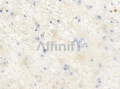 OR10A4 Antibody - DF5003 at 1/100 staining human astrocytoma by IHC-P.