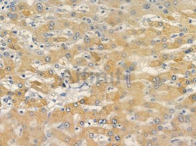 OR10C1 Antibody - DF5006 at 1/100 staining human hepatocellular carcinoma by IHC-P.