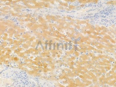 OR51G2 Antibody - DF5022 at 1/100 staining human hepatocellular carcinoma by IHC-P.