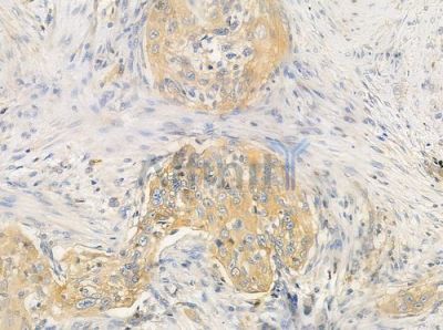 OR52E1 Antibody - DF5028 at 1/100 staining human tongue carcinoma by IHC-P.