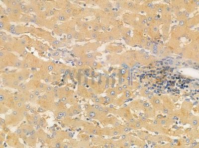 OR52E1 Antibody - DF5028 at 1/100 staining human hepatocellular carcinoma by IHC-P.