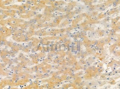 OR5AU1 Antibody - DF5035 at 1/100 staining human hepatocellular carcinoma by IHC-P.