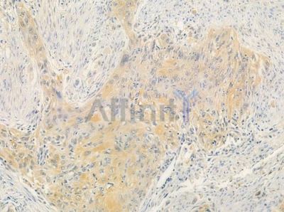 OR5AU1 Antibody - DF5035 at 1/100 staining human tongue carcinoma by IHC-P.
