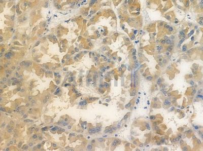 OR5AU1 Antibody - DF5035 at 1/100 staining human renal cell carcinoma by IHC-P.