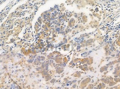 OR6C68 Antibody - DF5037 at 1/100 staining human lung adenocarcinoma by IHC-P.