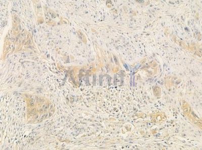 OR10H2 Antibody - DF5050 at 1/100 staining human tongue carcinoma by IHC-P.