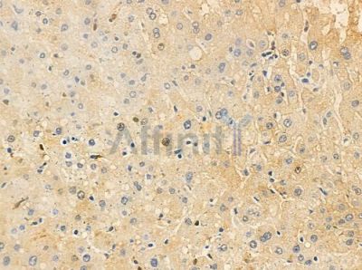 OR10H4 Antibody - DF5051 at 1/100 staining human hepatocellular carcinoma by IHC-P.