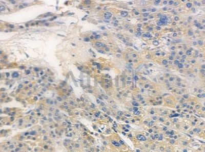 OR13F1 Antibody - DF5056 at 1/100 staining human hepatocellular carcinoma by IHC-P.
