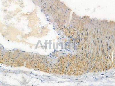 OR1S1/1S2 Antibody - DF5063 at 1/100 staining human testicular cancer by IHC-P.