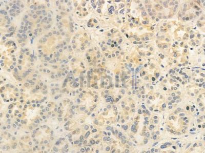 OR2M2 Antibody - DF5077 at 1/100 staining human renal cell carcinoma by IHC-P.