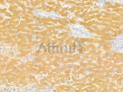 OR4A15 Antibody - DF5083 at 1/100 staining human hepatocellular carcinoma by IHC-P.