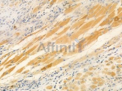OR4A16 Antibody - DF5084 at 1/100 staining human tongue carcinoma by IHC-P.