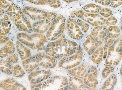 OR4C13 Antibody - DF5088 at 1/100 staining human renal cell carcinoma by IHC-P.