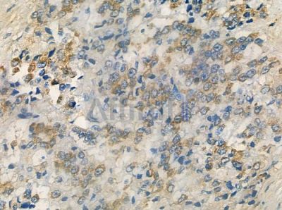OR4P4 Antibody - DF5097 at 1/100 staining human prostate carcinoma by IHC-P.