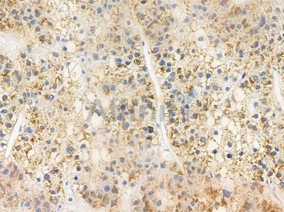 OR6C3 Antibody - DF5117 at 1/100 staining human hepatocellular carcinoma by IHC-P.