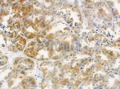 OR6T1 Antibody - DF5122 at 1/100 staining human renal cell carcinoma by IHC-P.