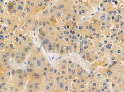 OR6T1 Antibody - DF5122 at 1/100 staining human hepatocellular carcinoma by IHC-P.