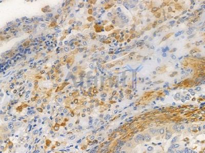 OR8G1 Antibody - DF5126 at 1/100 staining human lung adenocarcinoma by IHC-P.