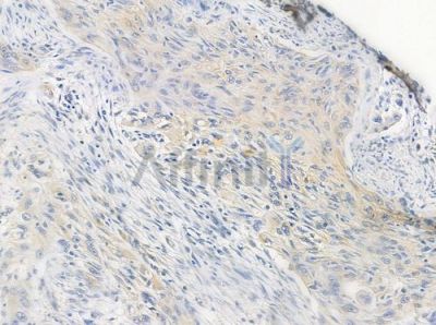OR8J1 Antibody - DF5129 at 1/100 staining human tongue carcinoma by IHC-P.