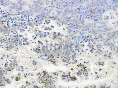 OR7E5P Antibody - DF5146 at 1/100 staining human melanoma by IHC-P.