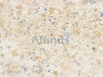 TAS2R39 Antibody - DF5161 at 1/100 staining human astrocytoma by IHC-P.