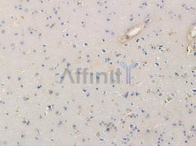 OR10Z1 Antibody - DF5185 at 1/100 staining human glioblastoma by IHC-P.