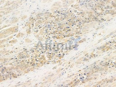OR51H1 Antibody - DF5190 at 1/100 staining human prostate carcinoma by IHC-P.