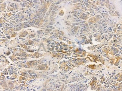 OR52N1 Antibody - DF5195 at 1/100 staining human lung adenocarcinoma by IHC-P.