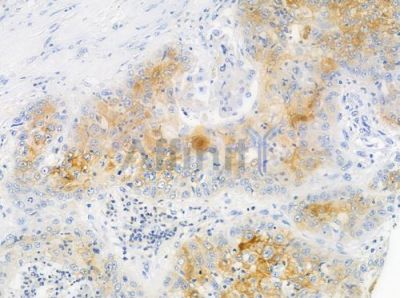 OR51A4 Antibody - DF5201 at 1/100 staining human esophageal carcinoma by IHC-P.