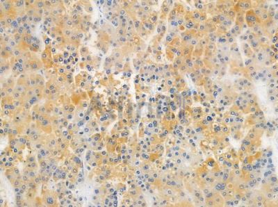 OR51A4 Antibody - DF5201 at 1/100 staining human hepatocellular carcinoma by IHC-P.