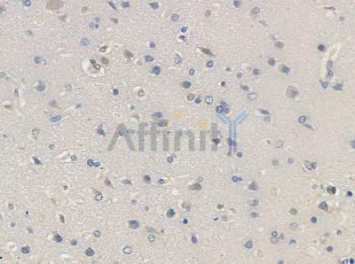 OR8D1 Antibody - DF5208 at 1/100 staining human glioblastoma by IHC-P.