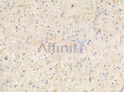 OR8G2 Antibody - DF5209 at 1/100 staining human astrocytoma by IHC-P.