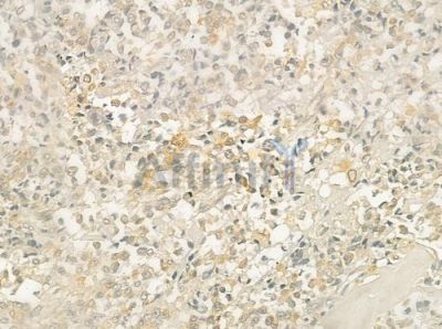 CD40L Antibody - DF6097 at 1/100 staining human prostate carcinoma by IHC-P.