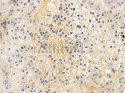 ANGPTL3 Antibody - DF6128 at 1/100 staining human hepatocellular carcinoma by IHC-P.