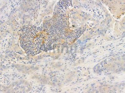 PRKAR1A Antibody - DF6142 at 1/100 staining human esophageal carcinoma by IHC-P.