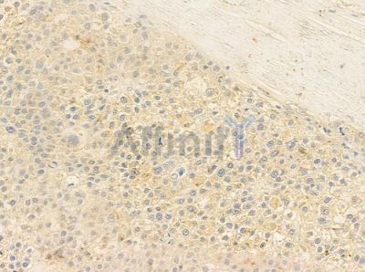 PIK3CB Antibody - DF6164 at 1/100 staining human hepatocellular carcinoma by IHC-P.