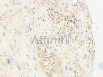 NEDD8 Antibody - DF6297 at 1/100 staining human prostate carcinoma by IHC-P.