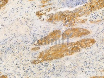 PDGFB Antibody - DF6328 at 1/100 staining human lung squamous cell carcinoma by IHC-P.