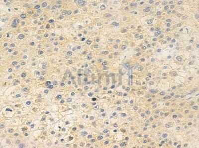 LCN6 Antibody - DF6336 at 1/100 staining human hepatocellular carcinoma by IHC-P.