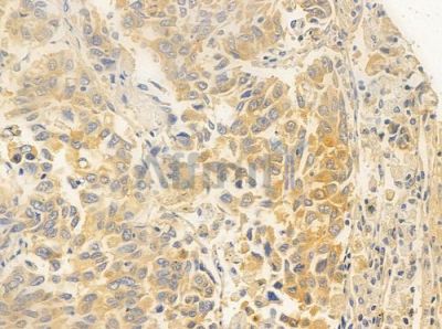 DEFB121 Antibody - DF6340 at 1/100 staining human lung squamous cell carcinoma by IHC-P.