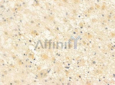 DEFB121 Antibody - DF6340 at 1/100 staining human astrocytoma by IHC-P.