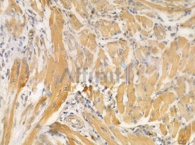 AK1 Antibody - DF6350 at 1/100 staining human tongue carcinoma by IHC-P.
