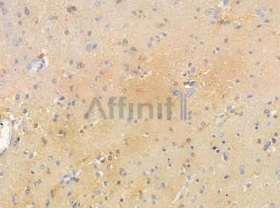 STIP1 Antibody - DF6351 at 1/100 staining human astrocytoma by IHC-P.