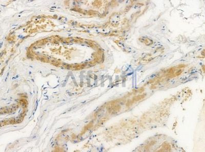 JNK2 Antibody - DF6382 at 1/100 staining human small cell lung carcinoma by IHC-P.
