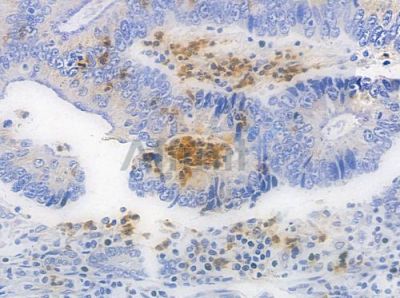 Cyclin D1 Antibody - DF6386 at 1/100 staining human colon carcinoma by IHC-P.